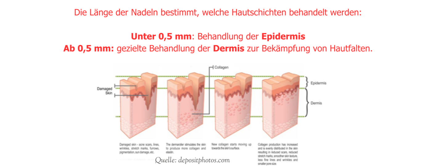was ist microneedling bild2